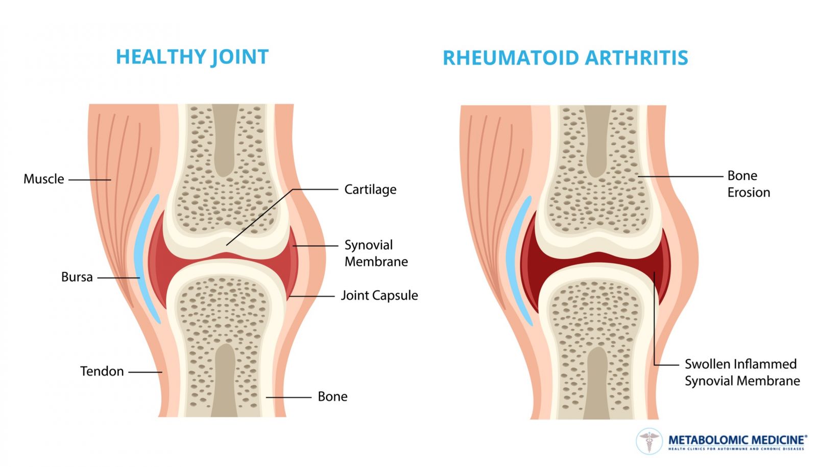 a boka rheumatoid arthritise súlyos fájdalom a keresztcsonti gerincben